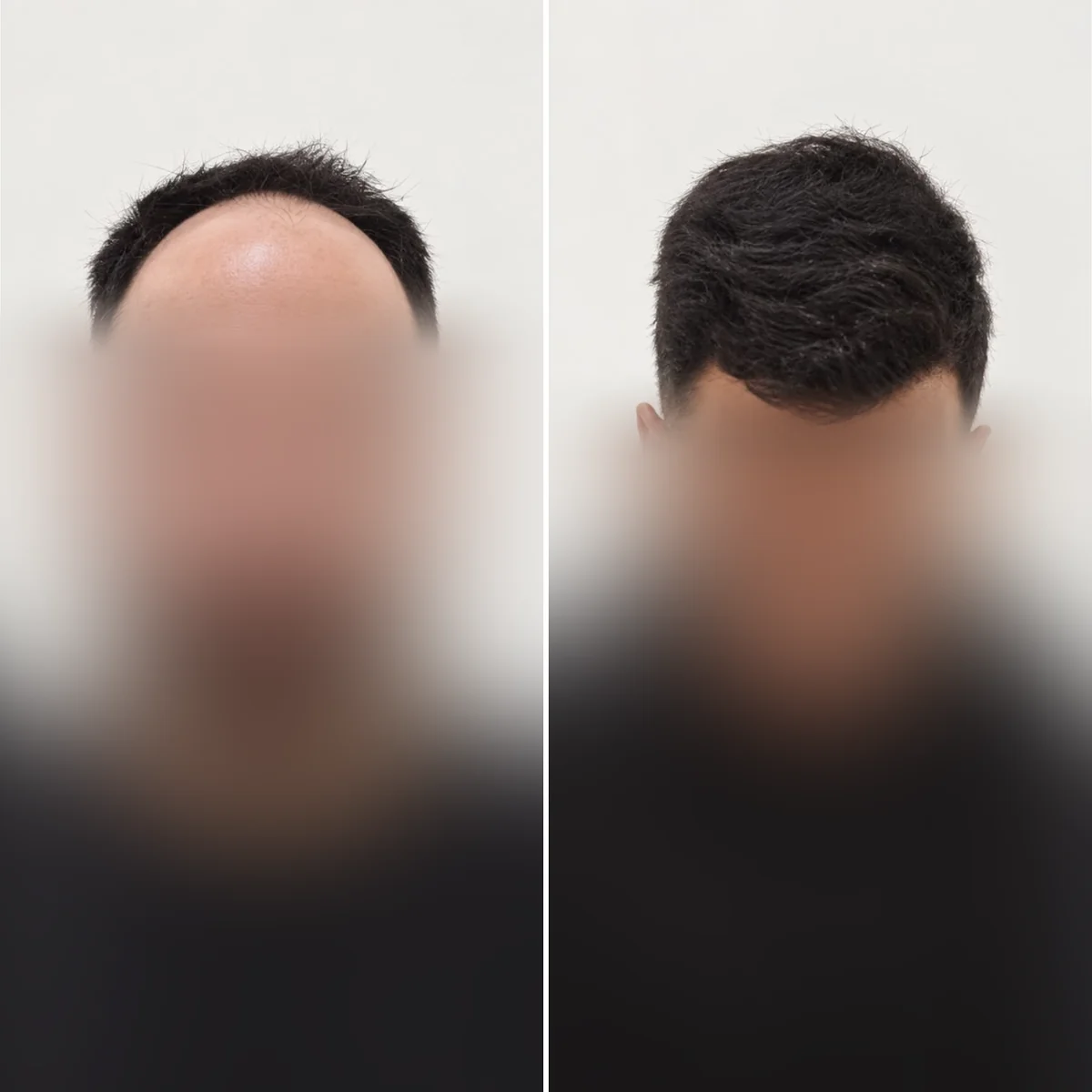 Comparação de antes e depois — Caso clínico 1