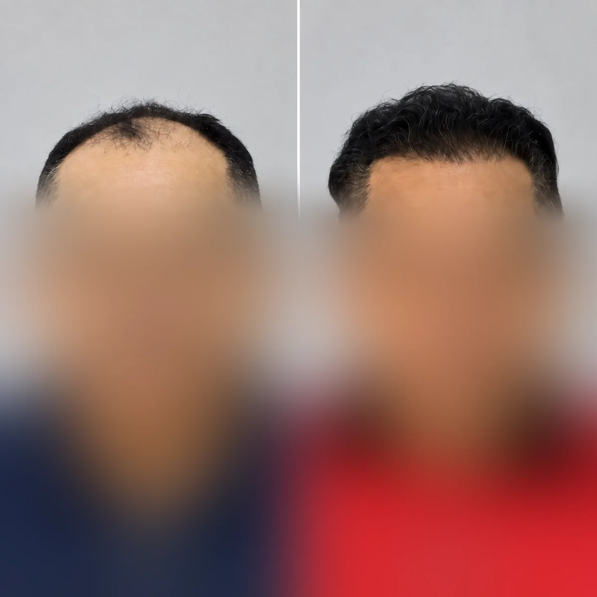 Comparação de antes e depois — Caso clínico 2