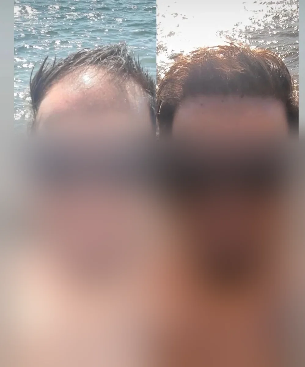 Comparação de antes e depois — Caso clínico 3
