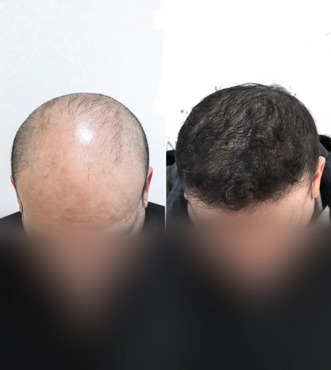 Comparação de antes e depois — Caso clínico 4